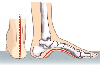 Chirurgia del piede