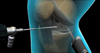 Chirurgia artroscopica e mini-invasiva